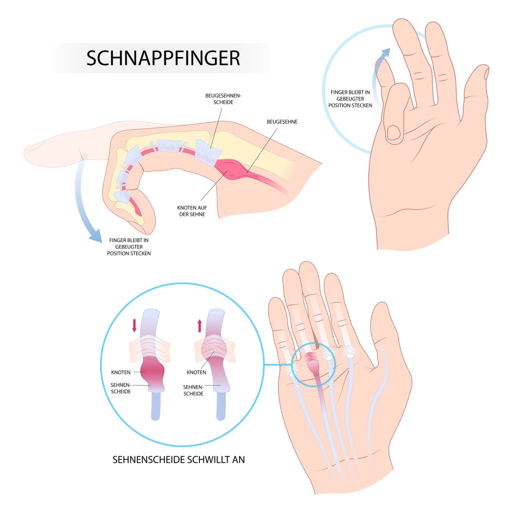 Abbildung eines schnellenden Fingers